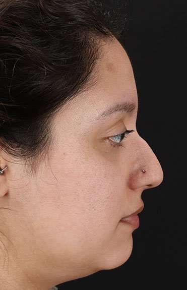 Cosmetic Injectables Before & After Patient #2253