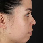 Cosmetic Injectables Before & After Patient #2264