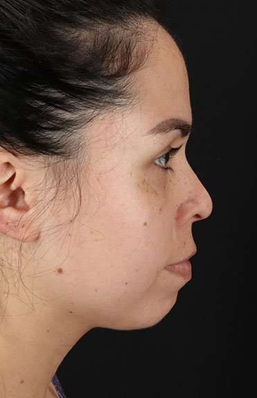 Cosmetic Injectables Before & After Patient #2264