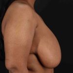 Breast Reduction with Lift Before & After Patient #928