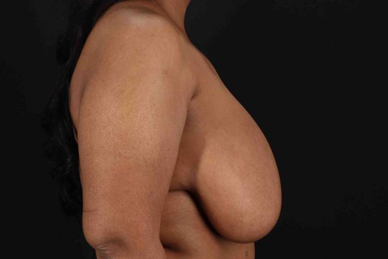 Breast Reduction with Lift Before & After Patient #928