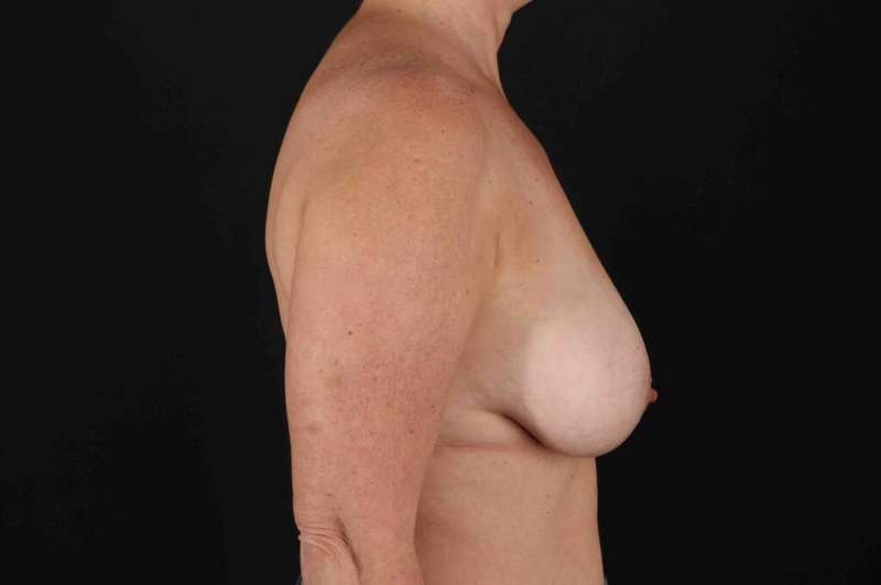 Breast Reduction with Lift Before & After Patient #939
