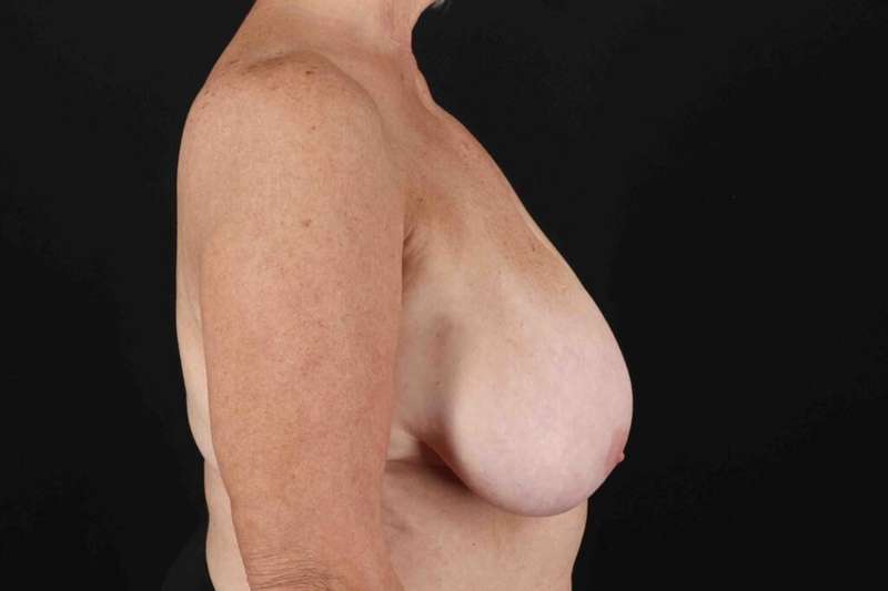 Breast Reduction with Lift Before & After Patient #1016