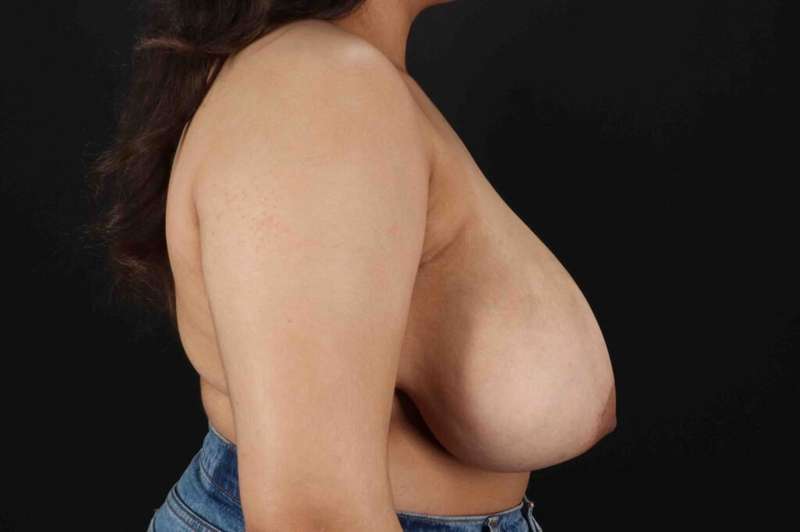Breast Reduction with Lift Before & After Patient #1027
