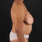 Breast Reconstruction Before & After Patient #1038