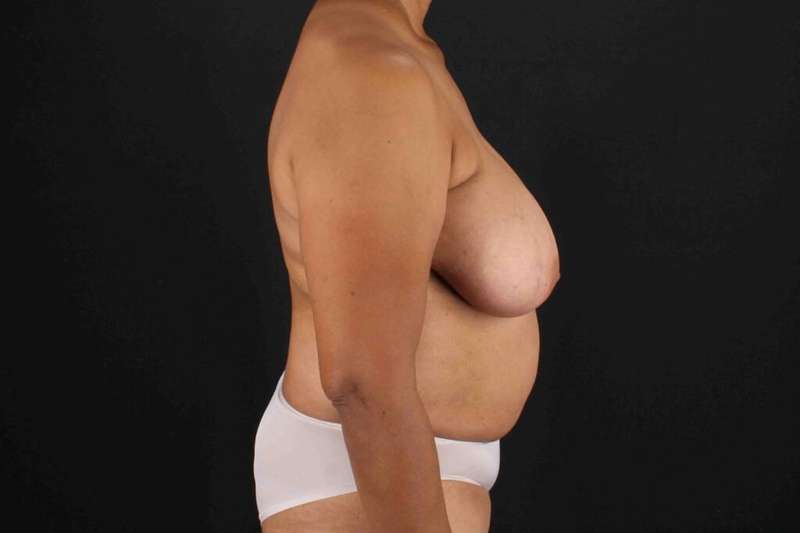 Breast Reconstruction Before & After Patient #1038