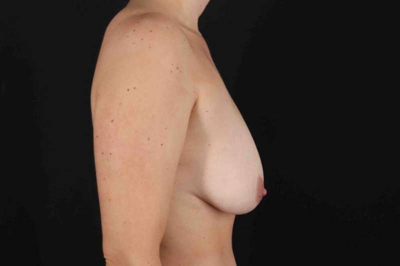 Breast Lift Before & After Patient #1104