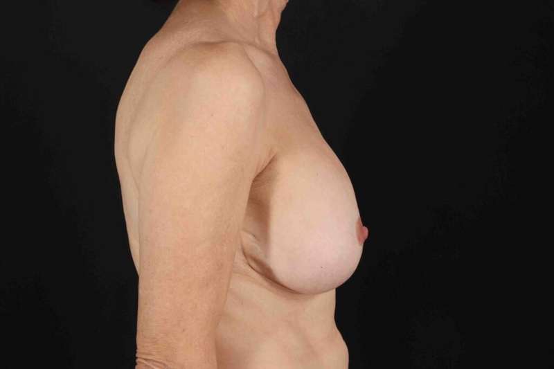 Breast Augmentation with Fat Transfer Before & After Patient #817