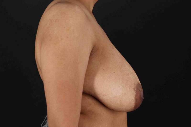 Breast Lift Before & After Patient #1159