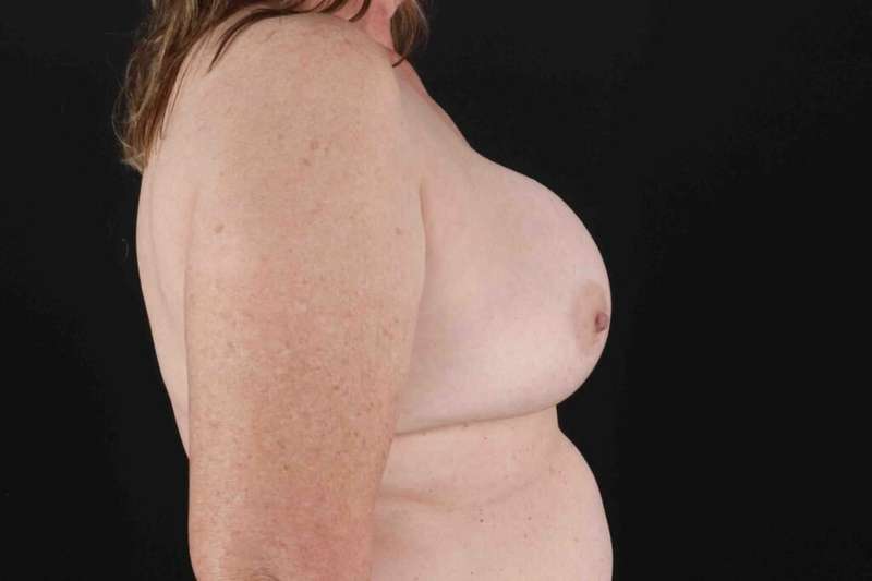 Breast Lift Before & After Patient #1181