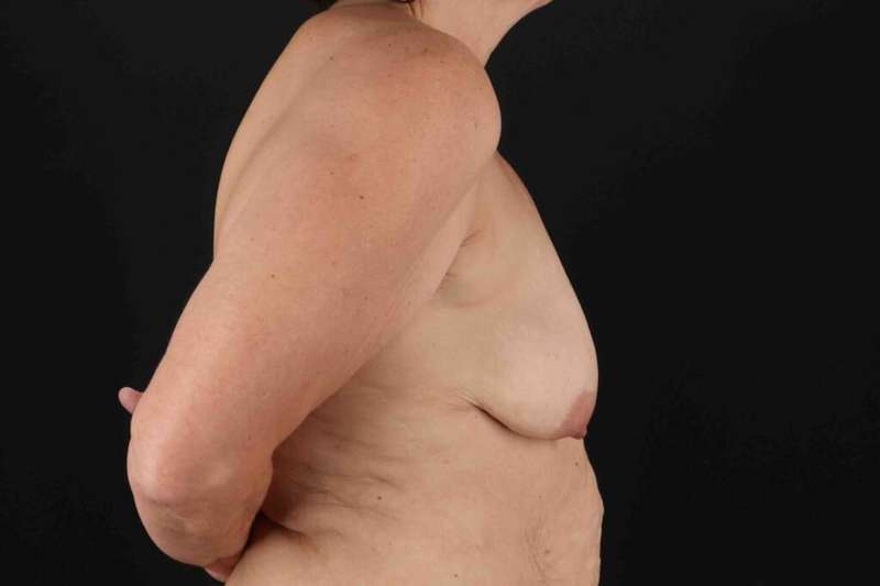 Breast Lift Before & After Patient #1192