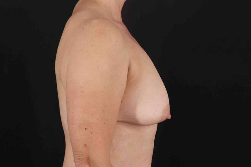 Breast Augmentation with Implants Before & After Patient #1225