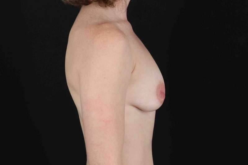 Breast Augmentation with Implants Before & After Patient #1247