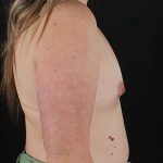 Breast Augmentation with Implants Before & After Patient #1258