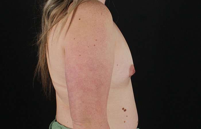 Breast Augmentation with Implants Before & After Patient #1258