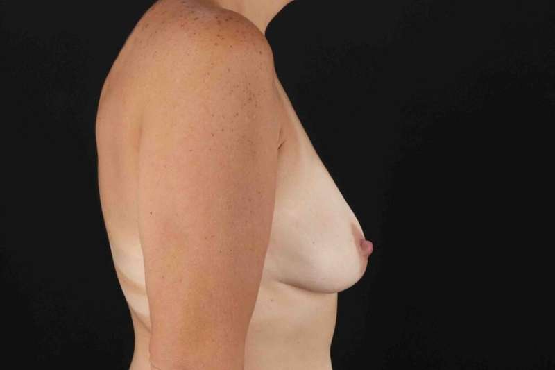 Breast Augmentation with Implants Before & After Patient #1269
