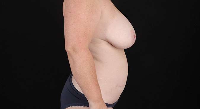Mommy Makeover Before & After Patient #1342