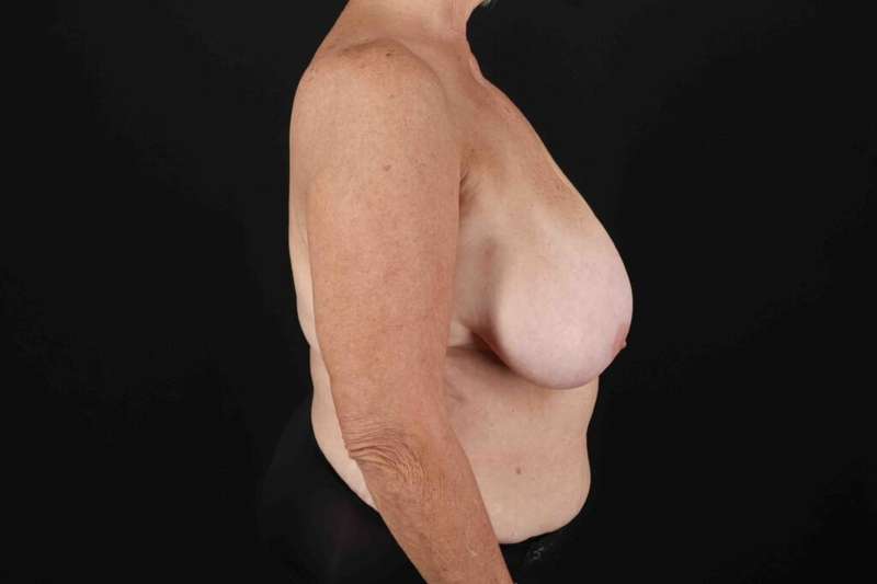 Mommy Makeover Before & After Patient #1353