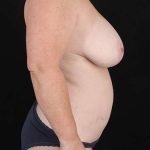 Liposuction Before & After Patient #1429