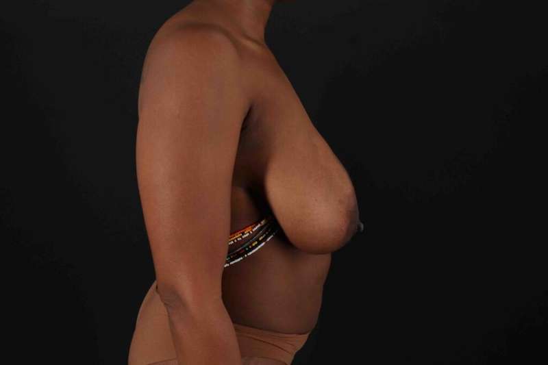 Tummy Tuck Before & After Patient #1451