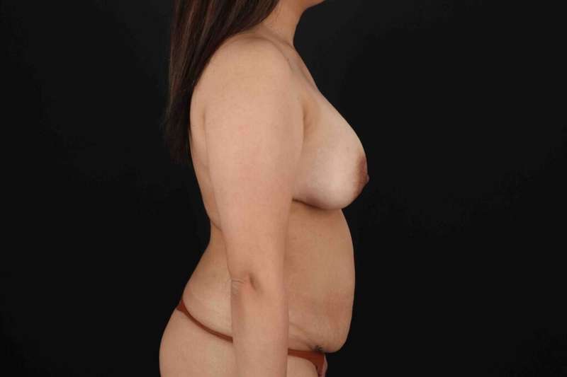 Tummy Tuck Before & After Patient #1528