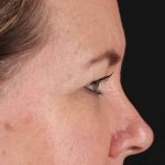 Brow Lift Before & After Patient #1566