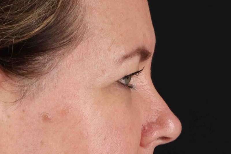 Brow Lift Before & After Patient #1566