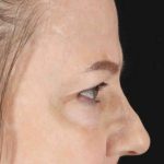 Brow Lift Before & After Patient #1577