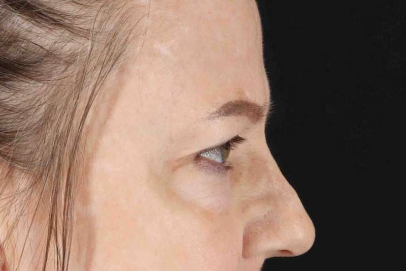 Brow Lift Before & After Patient #1577