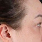 Brow Lift Before & After Patient #1588