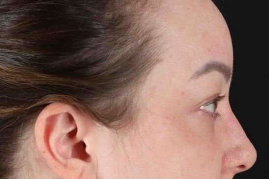 Brow Lift Before & After Patient #1588