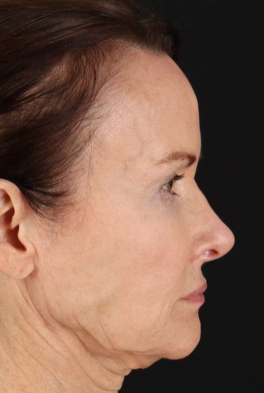 Face Lift Before & After Patient #1632
