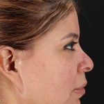 Face Lift Before & After Patient #1643