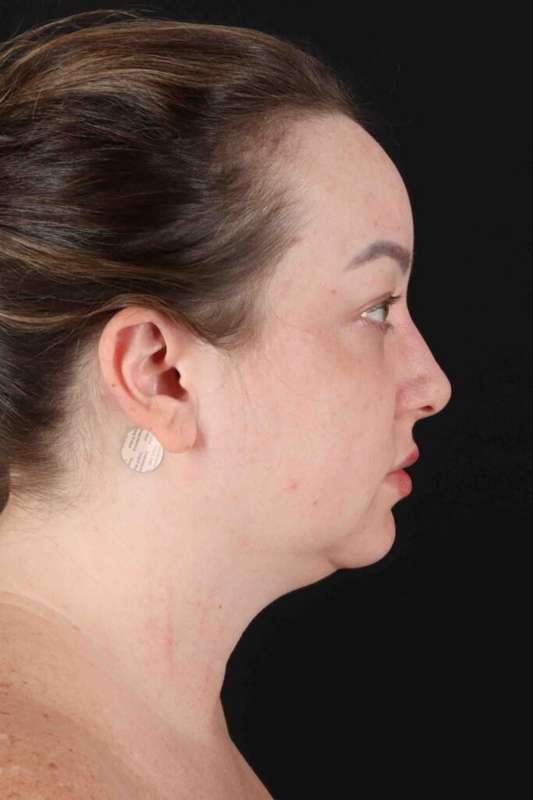 Face Lift Before & After Patient #1654
