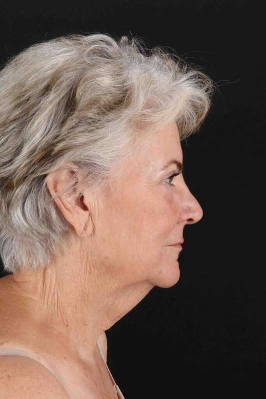 Neck Lift Before & After Patient #1676