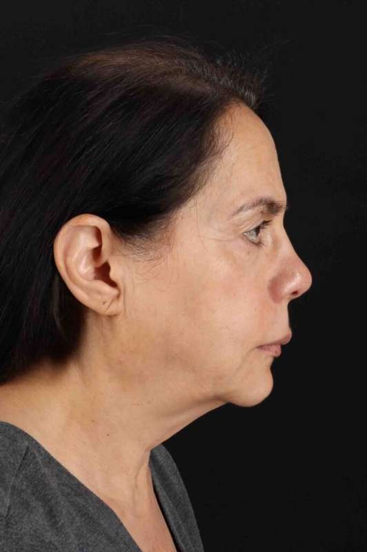 Neck Lift Before & After Patient #1687