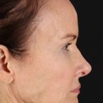 Neck Lift Before & After Patient #1698