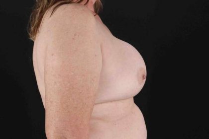 Breast Implant Removal Before & After Patient #872