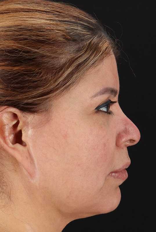 Neck Lift Before & After Patient #1709