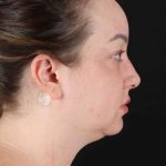 Neck Liposuction Before & After Patient #1742