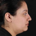 Neck Liposuction Before & After Patient #1753