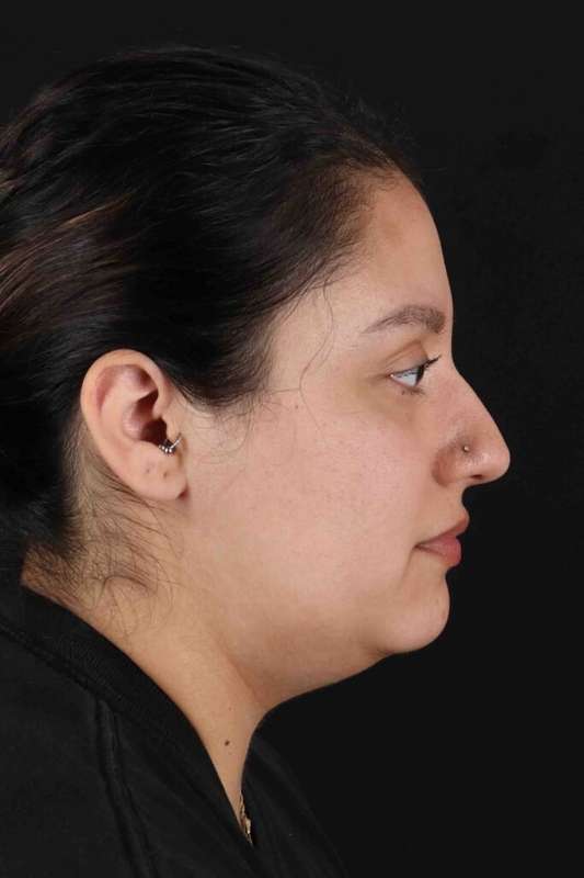 Neck Liposuction Before & After Patient #1753