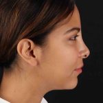 Neck Liposuction Before & After Patient #1764