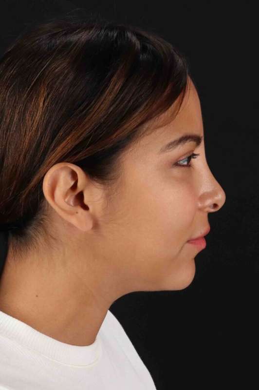 Neck Liposuction Before & After Patient #1764