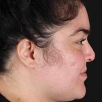 Neck Liposuction Before & After Patient #1775