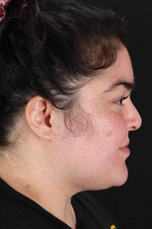 Neck Liposuction Before & After Patient #1775