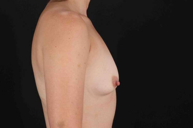 Breast Augmentation with Fat Transfer Before & After Patient #784