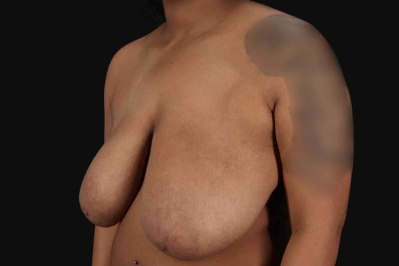 Breast Reduction with Lift Before & After Patient #905