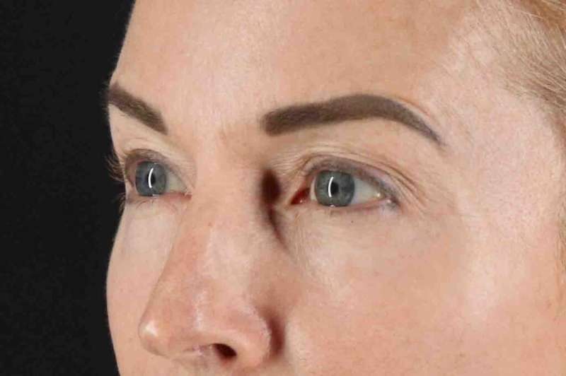 Laser Before & After Patient #2070