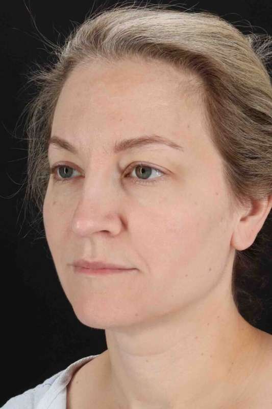 Laser Before & After Patient #2081